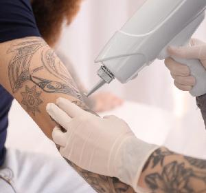 Удаление татуировок в Пензе